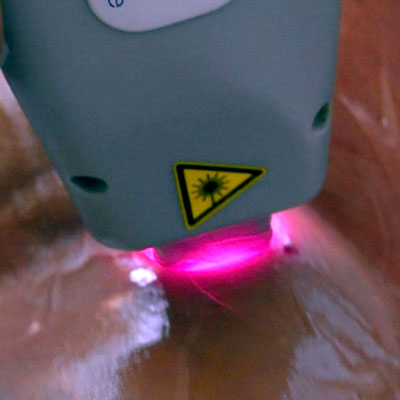 depilação a laser diodo